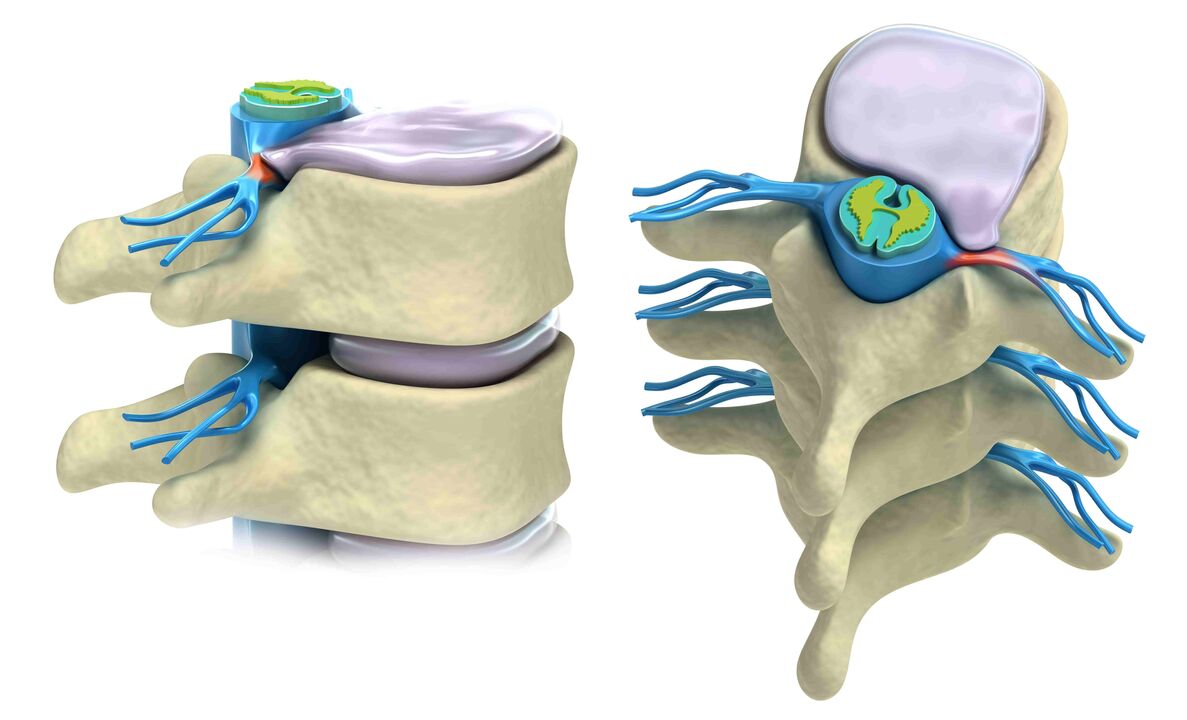 damaged spinal discs