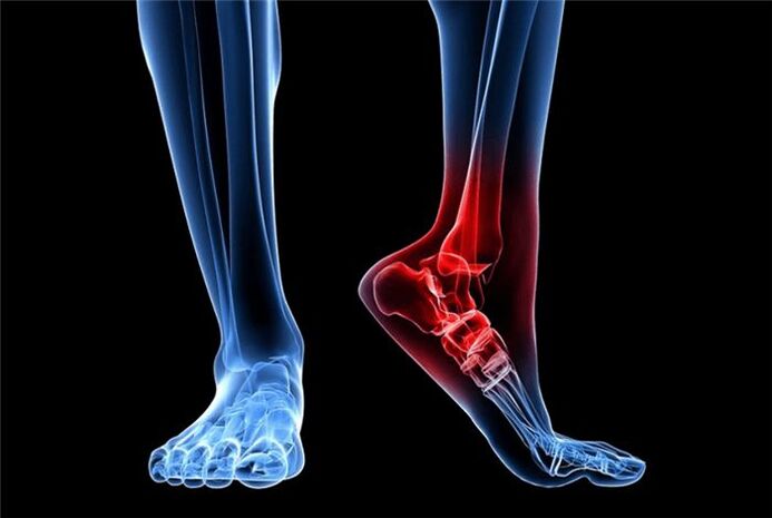 Arthritis of the foot