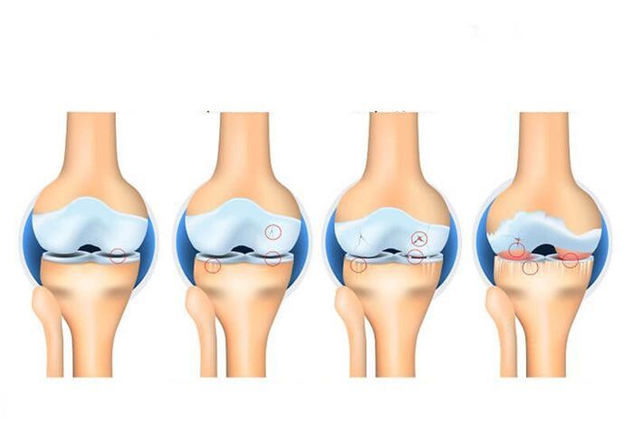 stages of joint disease