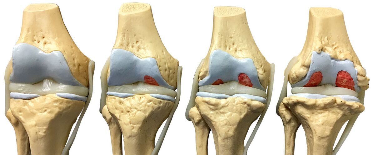 The stages of the knee joint