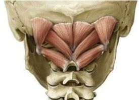 The deep muscles of the neck holding Atlant in the wrong position