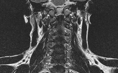 Uterine spine