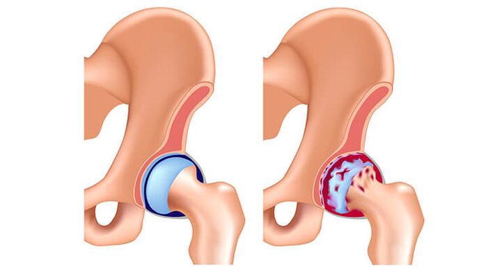 Arthrosis of hip joints